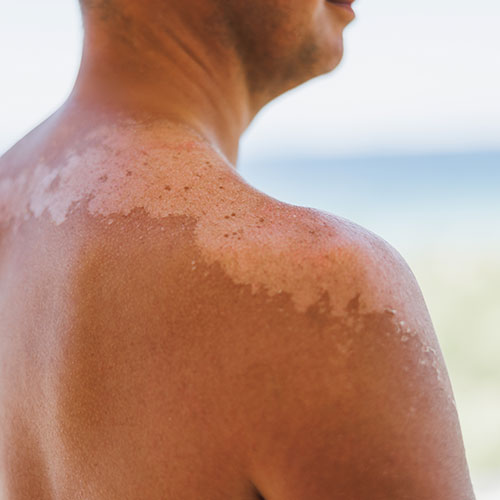 Persona con Quemadura solar en el hombro y como puede ayudarles los tratamientos