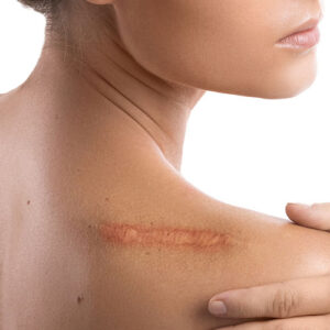 Chica mostrando una Herida extensa cicatrizada en la espalda
