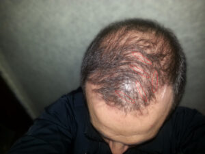 cuarto mes post implante de pelo